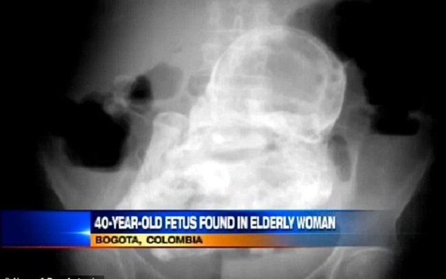 Döbbenet! 40 éves magzatot találtak a 82 éves asszony hasüregében