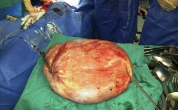 Huszonöt kilogrammos daganatot távolítottak el egy nő testéből